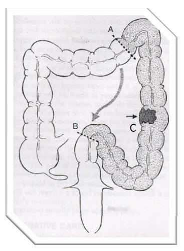 diagram for the position of tumour and colon segment